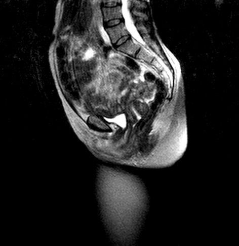 Pelvic Floor MRI scan 4